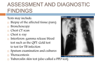 ASSESSMENT AND DIAGNOSTIC
FINDINGS
Tests may include:
 Biopsy of the affected tissue (rare)
 Bronchoscopy
 Chest CT scan
 Chest x-ray
 Interferon-gamma release blood
test such as the QFT-Gold test
to test for TB infection
 Sputum examination and cultures
 Thoracentesis
 Tuberculin skin test (also called a PPD test)
 