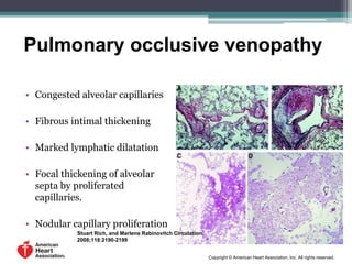 Stuart Rich, and Marlene Rabinovitch Circulation.
2008;118:2190-2199
Copyright © American Heart Association, Inc. All rights reserved.
Pulmonary occlusive venopathy
• Congested alveolar capillaries
• Fibrous intimal thickening
• Marked lymphatic dilatation
• Focal thickening of alveolar
septa by proliferated
capillaries.
• Nodular capillary proliferation
 