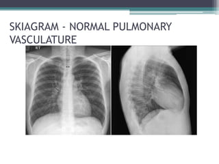 SKIAGRAM - NORMAL PULMONARY
VASCULATURE
 