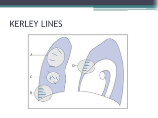KERLEY LINES
 