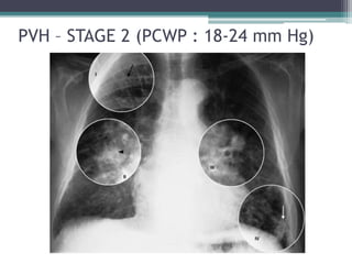 PVH – STAGE 2 (PCWP : 18-24 mm Hg)
 