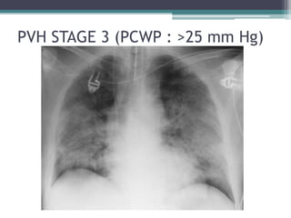 PVH STAGE 3 (PCWP : >25 mm Hg)
 