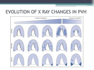 EVOLUTION OF X RAY CHANGES IN PVH
 