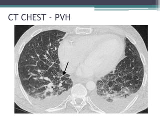 CT CHEST - PVH
 
