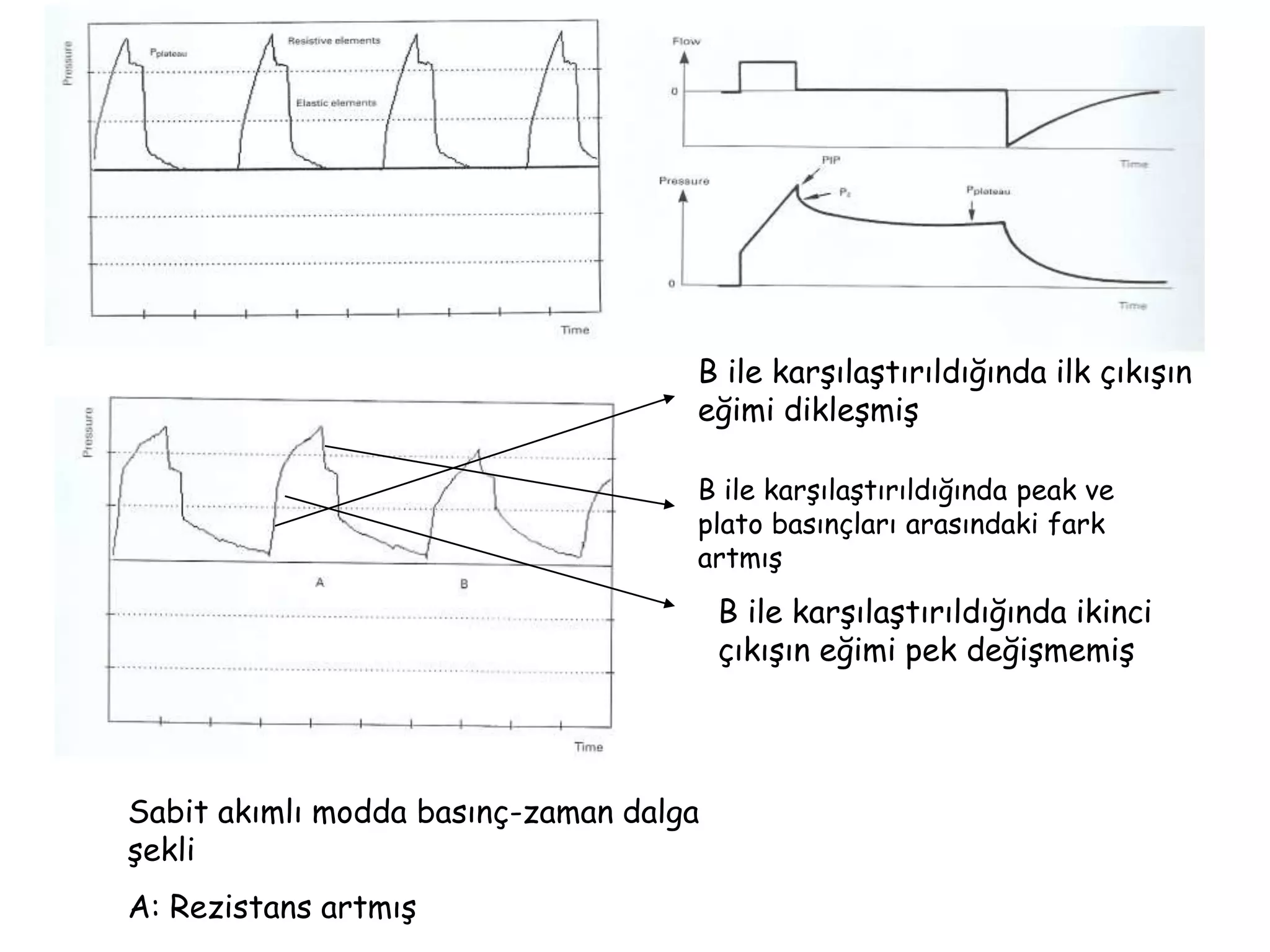 Sabit akımlı modda basınç-zaman dalga
şekli
A: Rezistans artmış
B ile karşılaştırıldığında ilk çıkışın
eğimi dikleşmiş
B ile karşılaştırıldığında peak ve
plato basınçları arasındaki fark
artmış
B ile karşılaştırıldığında ikinci
çıkışın eğimi pek değişmemiş
 