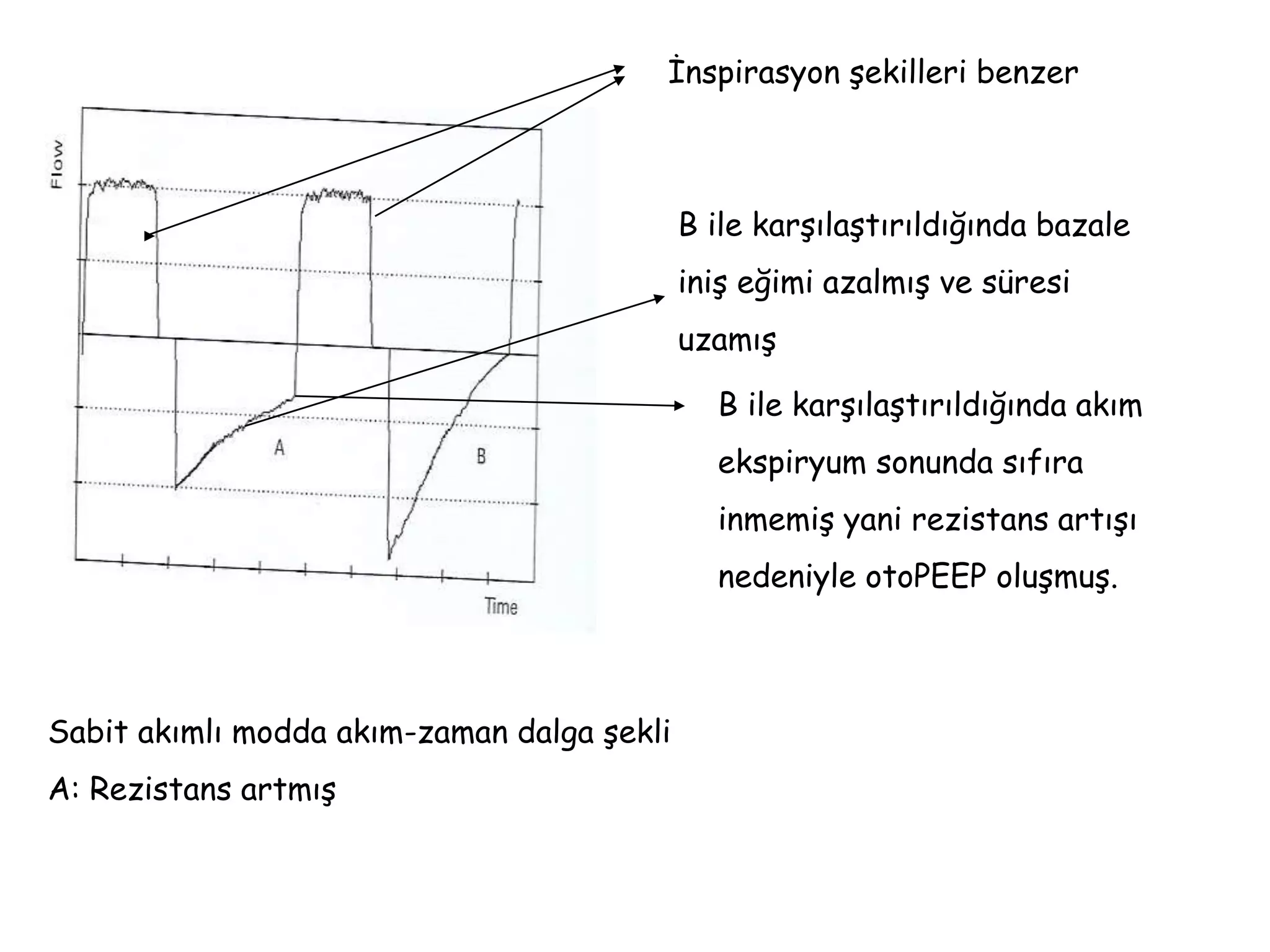 Sabit akımlı modda akım-zaman dalga şekli
A: Rezistans artmış
İnspirasyon şekilleri benzer
B ile karşılaştırıldığında bazale
iniş eğimi azalmış ve süresi
uzamış
B ile karşılaştırıldığında akım
ekspiryum sonunda sıfıra
inmemiş yani rezistans artışı
nedeniyle otoPEEP oluşmuş.
 
