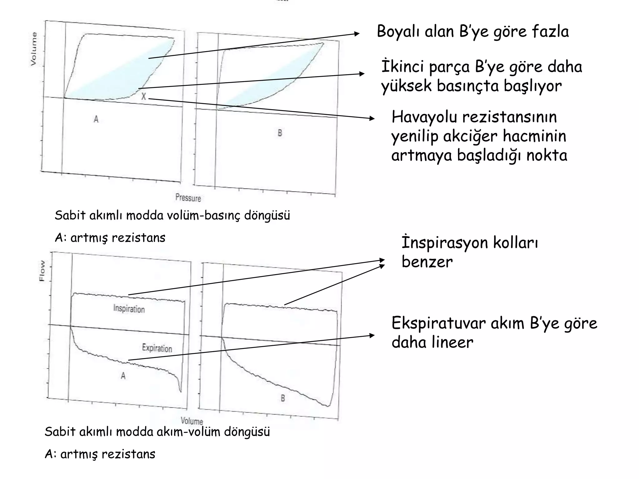 Sabit akımlı modda volüm-basınç döngüsü
A: artmış rezistans
Sabit akımlı modda akım-volüm döngüsü
A: artmış rezistans
Boyalı alan B’ye göre fazla
İkinci parça B’ye göre daha
yüksek basınçta başlıyor
Havayolu rezistansının
yenilip akciğer hacminin
artmaya başladığı nokta
İnspirasyon kolları
benzer
Ekspiratuvar akım B’ye göre
daha lineer
 