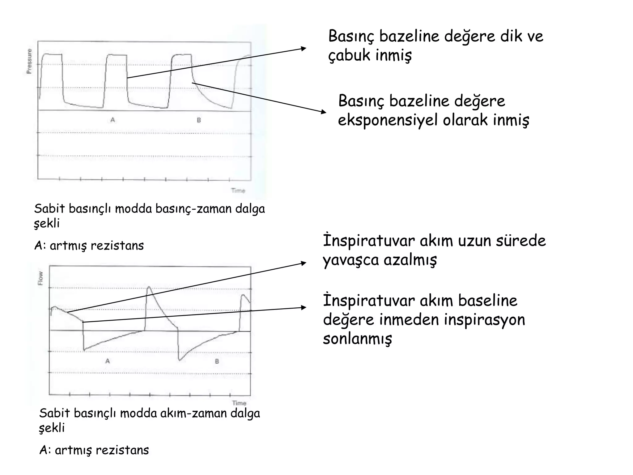 Sabit basınçlı modda basınç-zaman dalga
şekli
A: artmış rezistans
Sabit basınçlı modda akım-zaman dalga
şekli
A: artmış rezistans
Basınç bazeline değere dik ve
çabuk inmiş
Basınç bazeline değere
eksponensiyel olarak inmiş
İnspiratuvar akım uzun sürede
yavaşca azalmış
İnspiratuvar akım baseline
değere inmeden inspirasyon
sonlanmış
 