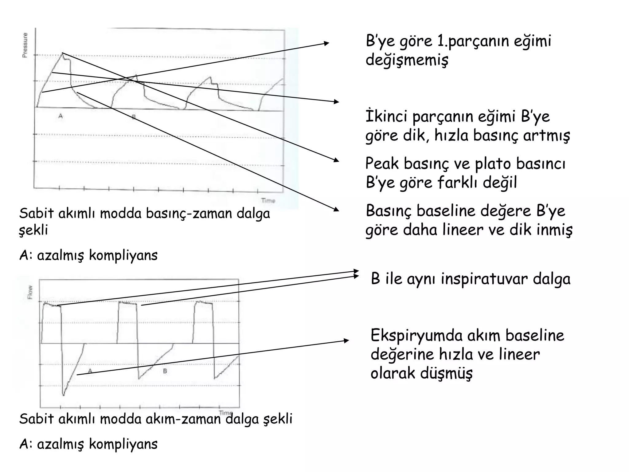 Sabit akımlı modda basınç-zaman dalga
şekli
A: azalmış kompliyans
Sabit akımlı modda akım-zaman dalga şekli
A: azalmış kompliyans
B’ye göre 1.parçanın eğimi
değişmemiş
İkinci parçanın eğimi B’ye
göre dik, hızla basınç artmış
Peak basınç ve plato basıncı
B’ye göre farklı değil
Basınç baseline değere B’ye
göre daha lineer ve dik inmiş
B ile aynı inspiratuvar dalga
Ekspiryumda akım baseline
değerine hızla ve lineer
olarak düşmüş
 