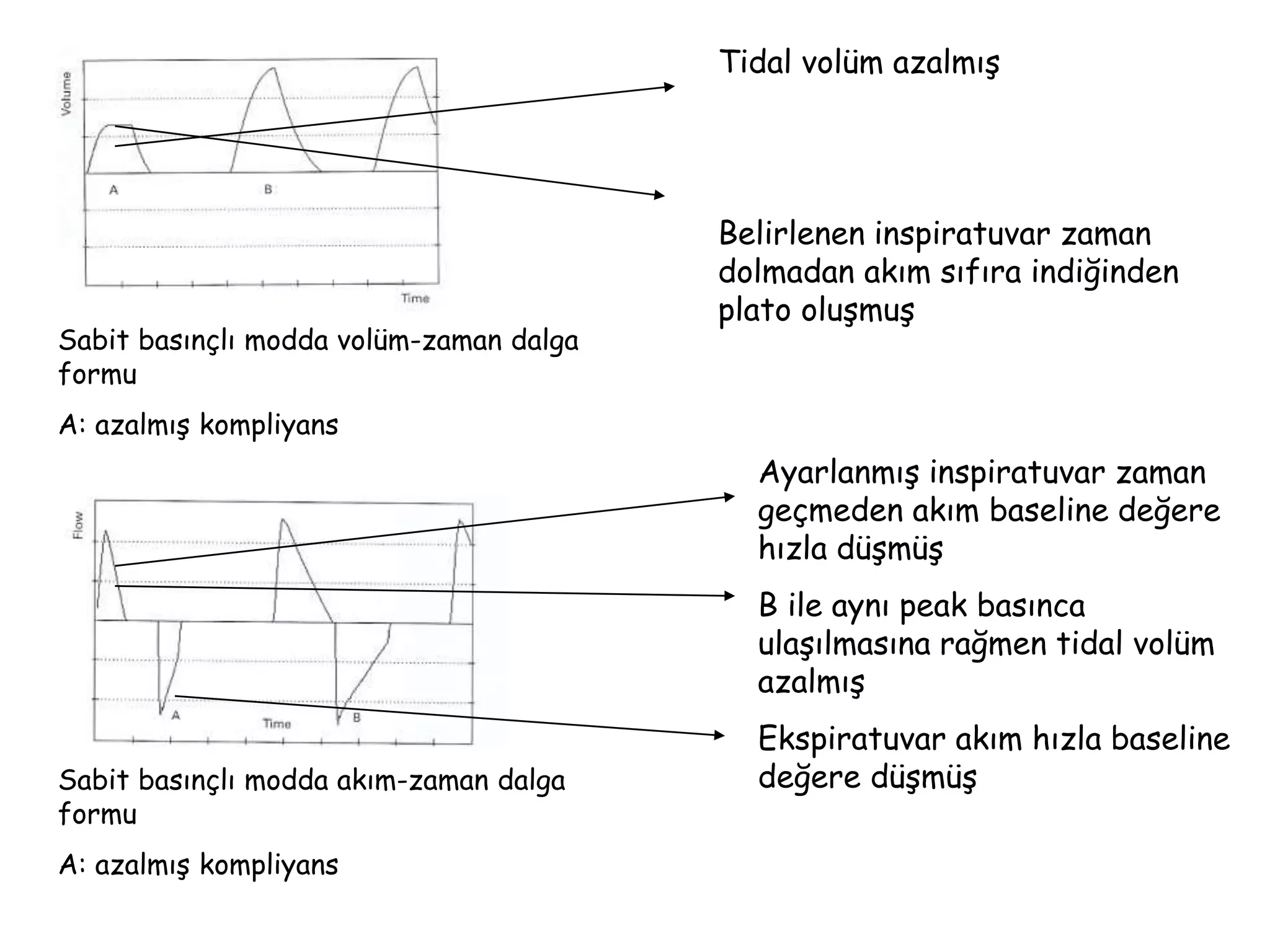 Sabit basınçlı modda volüm-zaman dalga
formu
A: azalmış kompliyans
Sabit basınçlı modda akım-zaman dalga
formu
A: azalmış kompliyans
Tidal volüm azalmış
Belirlenen inspiratuvar zaman
dolmadan akım sıfıra indiğinden
plato oluşmuş
Ayarlanmış inspiratuvar zaman
geçmeden akım baseline değere
hızla düşmüş
B ile aynı peak basınca
ulaşılmasına rağmen tidal volüm
azalmış
Ekspiratuvar akım hızla baseline
değere düşmüş
 