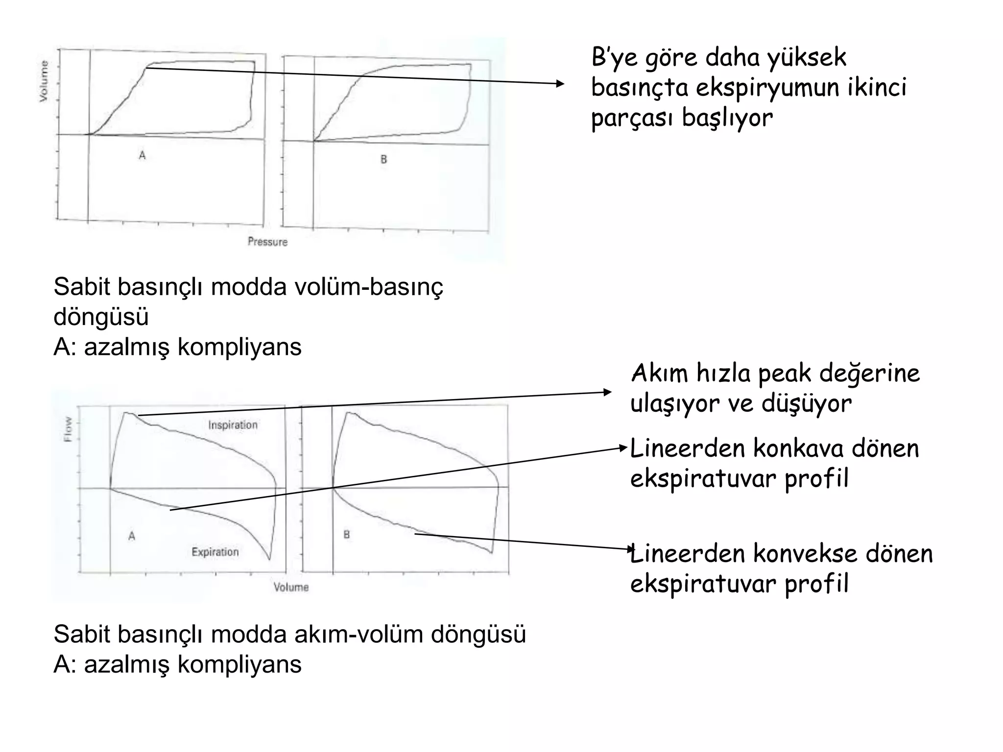 Sabit basınçlı modda akım-volüm döngüsü
A: azalmış kompliyans
Sabit basınçlı modda volüm-basınç
döngüsü
A: azalmış kompliyans
B’ye göre daha yüksek
basınçta ekspiryumun ikinci
parçası başlıyor
Akım hızla peak değerine
ulaşıyor ve düşüyor
Lineerden konkava dönen
ekspiratuvar profil
Lineerden konvekse dönen
ekspiratuvar profil
 