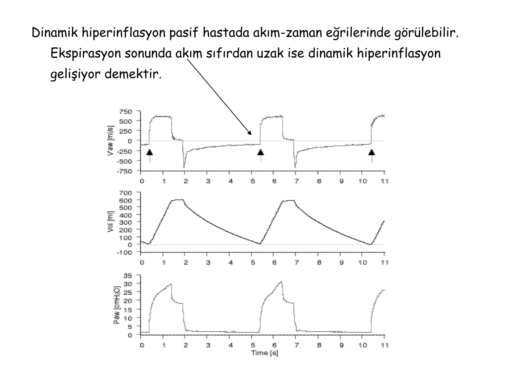 Dinamik hiperinflasyon pasif hastada akım-zaman eğrilerinde görülebilir.
Ekspirasyon sonunda akım sıfırdan uzak ise dinamik hiperinflasyon
gelişiyor demektir.
 