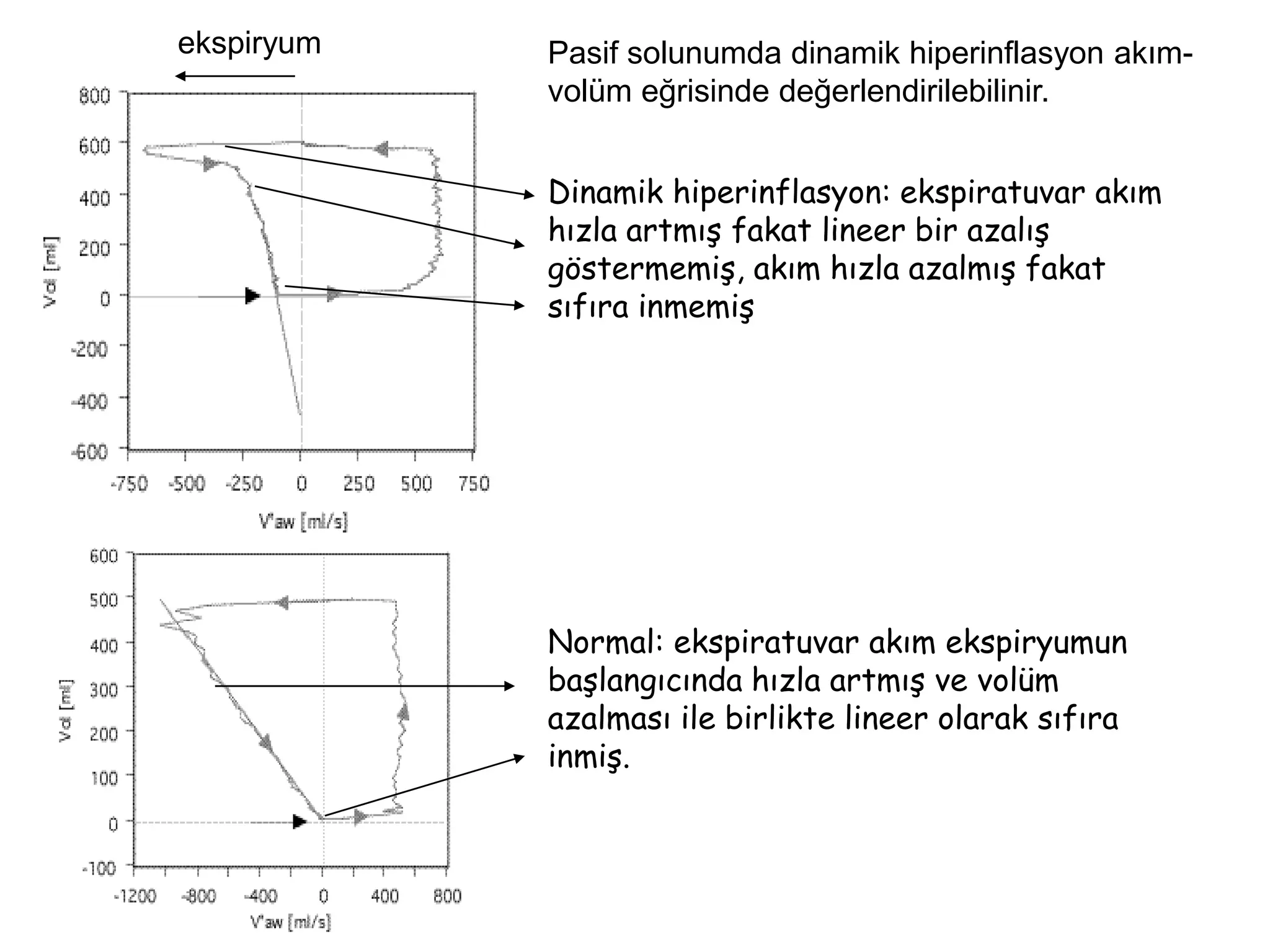 Normal: ekspiratuvar akım ekspiryumun
başlangıcında hızla artmış ve volüm
azalması ile birlikte lineer olarak sıfıra
inmiş.
ekspiryum
Dinamik hiperinflasyon: ekspiratuvar akım
hızla artmış fakat lineer bir azalış
göstermemiş, akım hızla azalmış fakat
sıfıra inmemiş
Pasif solunumda dinamik hiperinflasyon akım-
volüm eğrisinde değerlendirilebilinir.
 