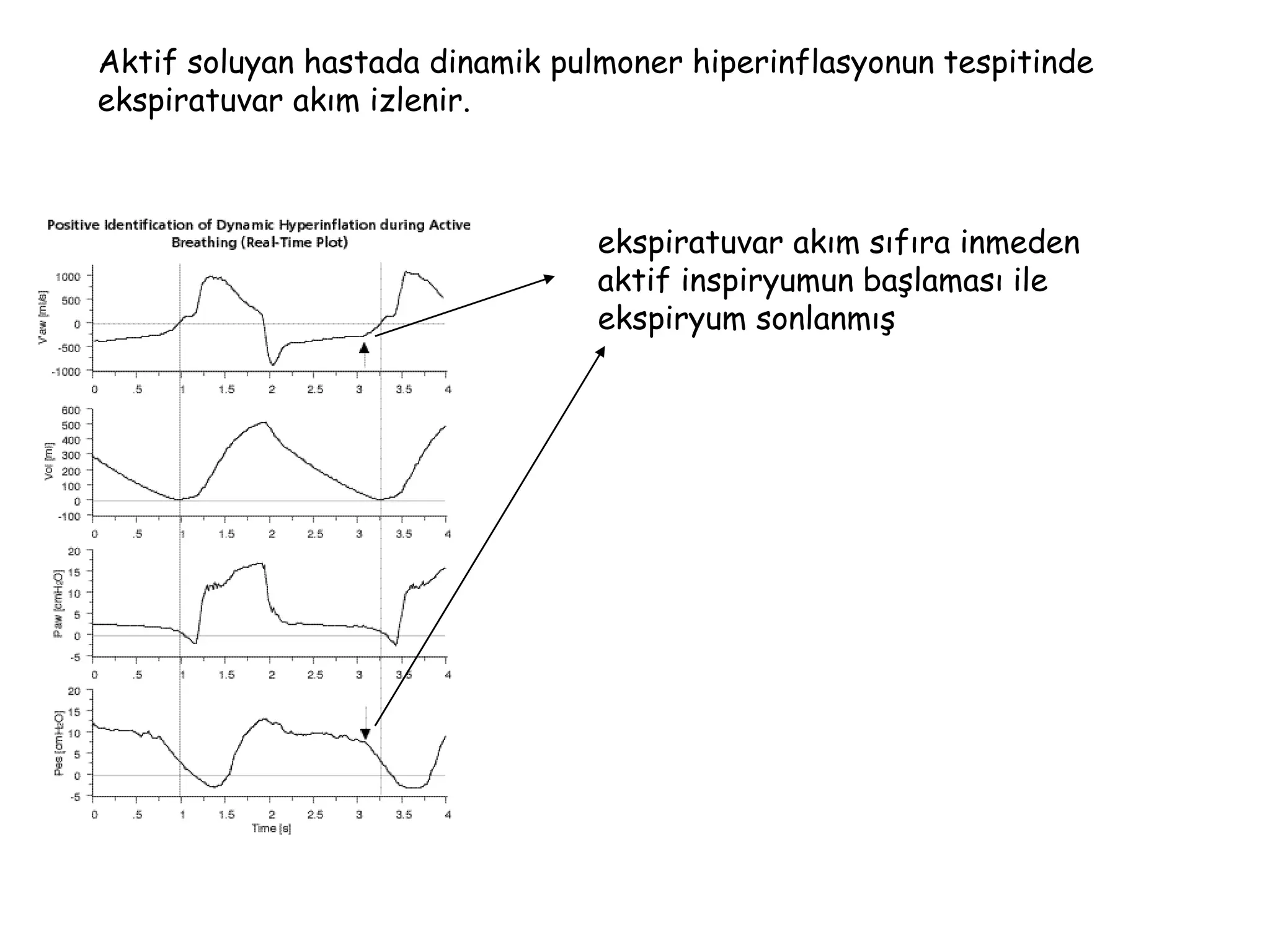 Aktif soluyan hastada dinamik pulmoner hiperinflasyonun tespitinde
ekspiratuvar akım izlenir.
ekspiratuvar akım sıfıra inmeden
aktif inspiryumun başlaması ile
ekspiryum sonlanmış
 