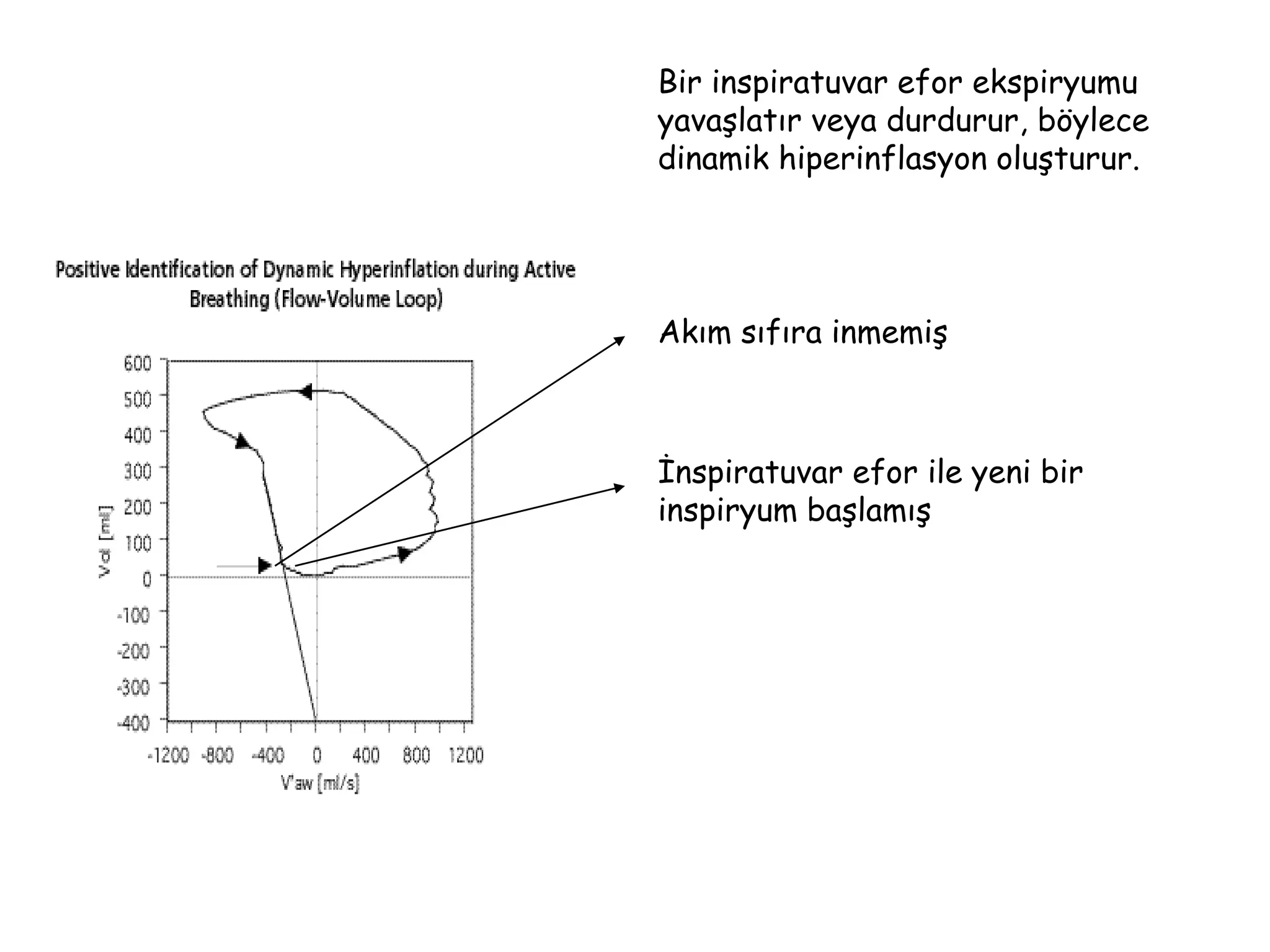 Bir inspiratuvar efor ekspiryumu
yavaşlatır veya durdurur, böylece
dinamik hiperinflasyon oluşturur.
Akım sıfıra inmemiş
İnspiratuvar efor ile yeni bir
inspiryum başlamış
 