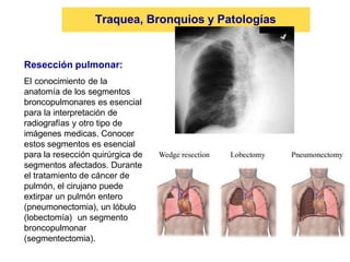 Resección pulmonar:
El conocimiento de la
anatomía de los segmentos
broncopulmonares es esencial
para la interpretación de
radiografías y otro tipo de
imágenes medicas. Conocer
estos segmentos es esencial
para la resección quirúrgica de
segmentos afectados. Durante
el tratamiento de cáncer de
pulmón, el cirujano puede
extirpar un pulmón entero
(pneumonectomia), un lóbulo
(lobectomía) un segmento
broncopulmonar
(segmentectomia).
Traquea, Bronquios y Patologías
 