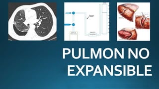 PULMONNO
EXPANSIBLE
 