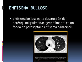 ENFISEMA BULLOSO

 enfisema bulloso es la destrucción del
  parénquima pulmonar, generalmente en un
  fondo de paraseptal...