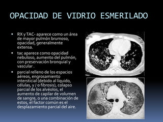 OPACIDAD DE VIDRIO ESMERILADO
 RX y TAC- aparece como un área
  de mayor pulmón brumoso,
  opacidad, generalmente
  extensa.
 tac aparece como opacidad
  nebuloso, aumento del pulmón,
  con preservación bronquial y
  vascular .
 parcial relleno de los espacios
  aéreos, engrosamiento
  intersticial (debido al líquido,
  células, y / o fibrosis), colapso
  parcial de los alvéolos, el
  aumento de capilar de volumen
  de sangre, o una combinación de
  estos, el factor común es el
  desplazamiento parcial del aire.
 