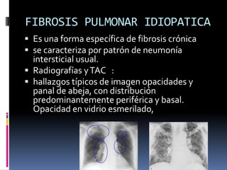 FIBROSIS PULMONAR IDIOPATICA
 Es una forma específica de fibrosis crónica
 se caracteriza por patrón de neumonía
  intersticial usual.
 Radiografías y TAC :
 hallazgos típicos de imagen opacidades y
  panal de abeja, con distribución
  predominantemente periférica y basal.
  Opacidad en vidrio esmerilado,
 