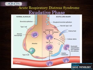 Acute Respiratory Distress Syndrome
Exudative Phase
 