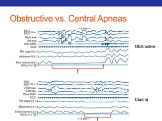 Obstructive vs. Central Apneas 
Obstructive 
Central 
 