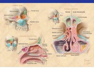Anatomic landmarks of the nasal cavity 
and paranasal sinuses. 
 