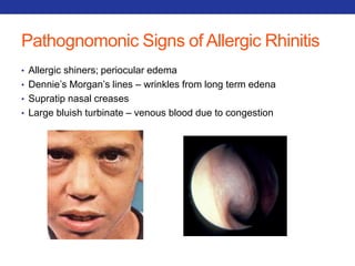 Pathognomonic Signs of Allergic Rhinitis 
• Allergic shiners; periocular edema 
• Dennie’s Morgan’s lines – wrinkles from long term edena 
• Supratip nasal creases 
• Large bluish turbinate – venous blood due to congestion 
 
