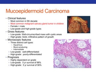 Mucoepidermoid Carcinoma 
• Clinical features 
• Most common in 5th decade 
• Most common malignant salivary gland tumor in children 
• Female > male 
• Low-grade and high-grade types 
• Gross features 
• Low-grade: Well-circumscribed mass with cystic areas 
• High-grade: Solid, infiltrative pattern of growth 
• Microscopic features 
• Three distinct cell types: 
• Squamous 
• Mucin-producing 
• Intermediate 
• Low-grade: well-differentiated 
• High-grade: poorly-differentiated 
• Prognosis 
• Highly dependent on grade 
• Low-grade: 5 yr survival of 98% 
• High-grade: 5 yr survival of 56% 
 