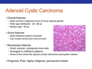 Adenoid Cystic Carcinoma 
• Clinical features 
• Most common malignant tumor of minor salivary glands 
• Wide age distribution: 20 - 80 yo 
• Median age = 50 yo 
• Gross features 
• Solid infiltrative pattern of growth 
• Can invade nerves and move to brain 
• Microscopic features 
• Small, cuboidal, cytologically bland cells 
• Arranged in cribriform patterns 
• Some of the lumen-like spaces contain distinctive eosinophilic materia 
• Prognosis: Poor, highly malignant, perineural invasion 
 