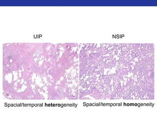 UIP NSIP 
Spacial/temporal heterogeneity Spacial/temporal homogeneity 
 