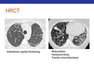 HRCT 
Interlobular septal thickening Reticulation 
Honeycombing 
Traction bronchiectasis 
 