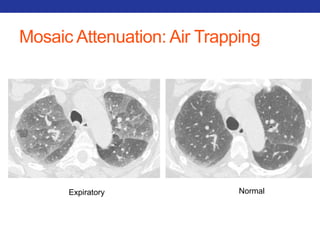 Mosaic Attenuation: Air Trapping 
Expiratory Normal 
 