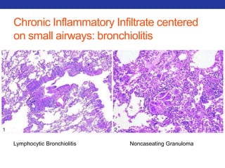 Chronic Inflammatory Infiltrate centered 
on small airways: bronchiolitis 
Lymphocytic Bronchiolitis Noncaseating Granuloma 
 