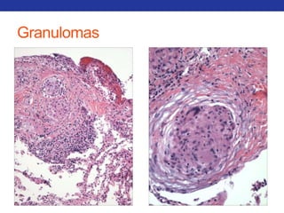 Granulomas 
 