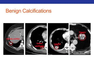 Benign Calcifications 
 