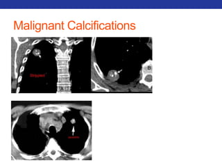 Malignant Calcifications 
 