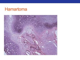 Hamartoma 
 