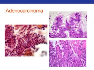 Adenocarcinoma 
 