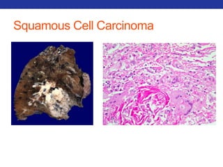 Squamous Cell Carcinoma 
 