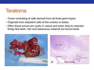 Teratoma 
• Tumor consisting of cells derived from all three germ layers 
• Originate from totipotent cells of the ovaries or testes. 
• Often these tumors are cystic in nature and when they’re resected 
things like teeth, hair and sebaceous material are found inside 
 