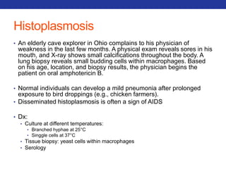 Histoplasmosis 
• An elderly cave explorer in Ohio complains to his physician of 
weakness in the last few months. A physical exam reveals sores in his 
mouth, and X-ray shows small calcifications throughout the body. A 
lung biopsy reveals small budding cells within macrophages. Based 
on his age, location, and biopsy results, the physician begins the 
patient on oral amphotericin B. 
• Normal individuals can develop a mild pneumonia after prolonged 
exposure to bird droppings (e.g., chicken farmers). 
• Disseminated histoplasmosis is often a sign of AIDS 
• Dx: 
• Culture at different temperatures: 
• Branched hyphae at 25°C 
• Singgle cells at 37°C 
• Tissue biopsy: yeast cells within macrophages 
• Serology 
 