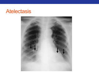 Atelectasis 
 