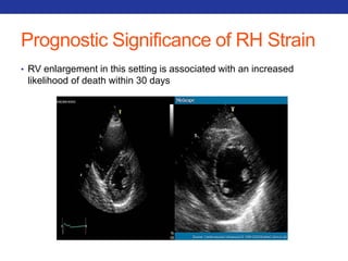 Prognostic Significance of RH Strain 
• RV enlargement in this setting is associated with an increased 
likelihood of death within 30 days 
 