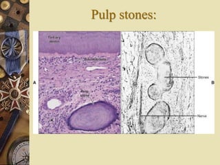 Pulp stones:
 