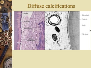 Diffuse calcifications
 
