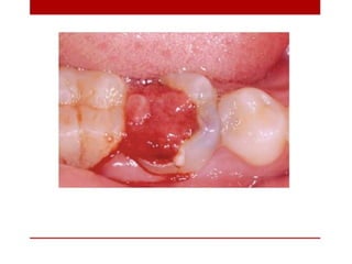pulp-and-periapical-lesions-of-the-tooth-ppt.pdf