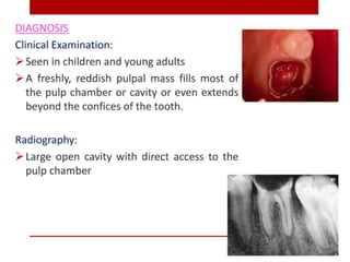 pulp-and-periapical-lesions-of-the-tooth-ppt.pdf