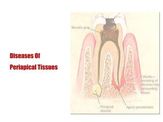 pulp-and-periapical-lesions-of-the-tooth-ppt.pdf
