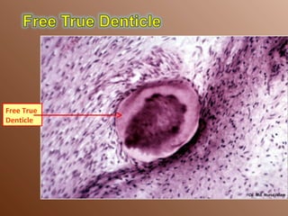 Free True
Denticle
 